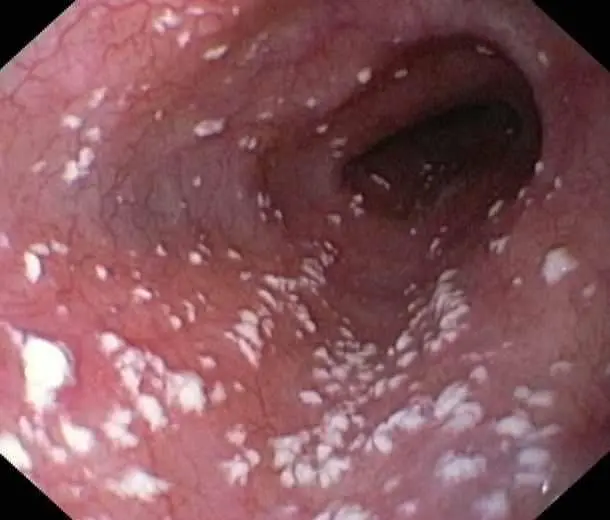 candida growth in GI tract