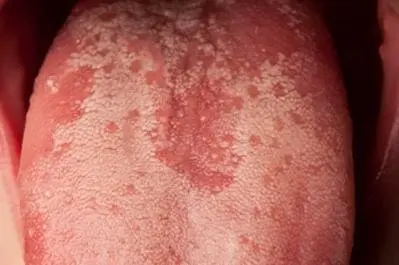candida on tongue