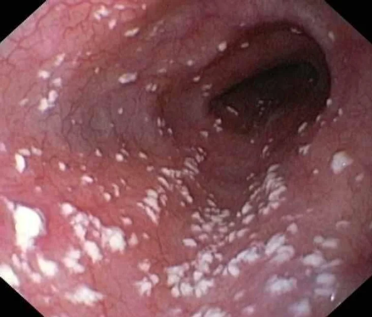 candida growing in GI tract
